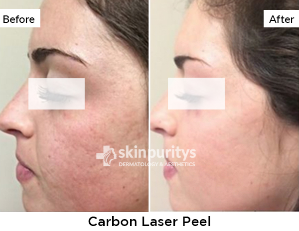 Carbon Peel results